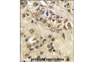 Formalin-fixed and paraffin-embedded human prostata carcinoma tissue reacted with MYC Antibody (T58) (ABIN388723 and ABIN2838831) , which was peroxidase-conjugated to the secondary antibody, followed by DAB staining. (c-MYC antibody  (AA 36-65))