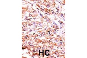 Formalin-fixed and paraffin-embedded human hepatocellular carcinoma tissue reacted with GUCY1A2 polyclonal antibody  , which was peroxidase-conjugated to the secondary antibody, followed by AEC staining.