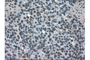 Immunohistochemical staining of paraffin-embedded Adenocarcinoma of breast tissue using anti-SOD1 mouse monoclonal antibody. (SOD1 antibody)