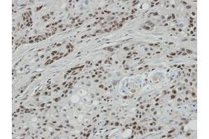 IHC-P Image Immunohistochemical analysis of paraffin-embedded oral CA cell lines Ca922 xenograft, using BCL7A, antibody at 1:100 dilution. (BCL7A antibody  (C-Term))