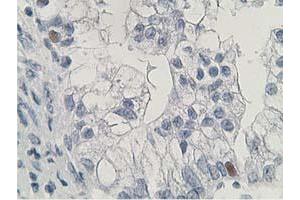 Immunohistochemical staining of paraffin-embedded Adenocarcinoma of Human ovary tissue using anti-HDHD2 mouse monoclonal antibody. (HDHD2 antibody)