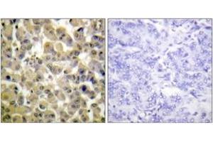 Immunohistochemistry analysis of paraffin-embedded human breast carcinoma, using MSK1 (Phospho-Ser360) Antibody. (MSK1 antibody  (pSer360))
