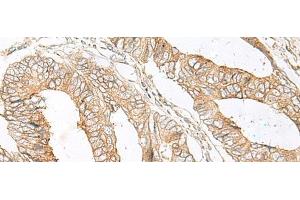 Immunohistochemistry of paraffin-embedded Human colorectal cancer tissue using SLC5A1 Polyclonal Antibody at dilution of 1:80(x200) (SLC5A1 antibody)