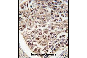 Formalin-fixed and paraffin-embedded human lung carcinoma tissue reacted with SFRS2 antibody (N-term), which was peroxidase-conjugated to the secondary antibody, followed by DAB staining. (SRSF2 antibody  (N-Term))