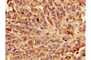 Immunohistochemistry of paraffin-embedded human melanoma using ABIN7154332 at dilution of 1:100 (BLZF1 antibody  (AA 11-99))