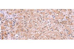 Immunohistochemistry of paraffin-embedded Human liver cancer tissue using RIC3 Polyclonal Antibody at dilution of 1:90(x200)