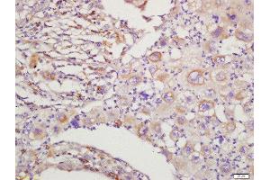 Formalin-fixed and paraffin embedded human lung cancer labeled with Rabbit Anti-RAC1+RAC2 Polyclonal Antibody, Unconjugated  at 1:200 followed by conjugation to the secondary antibody and DAB staining (RAC1 antibody  (AA 101-192))
