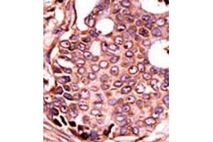 Formalin-fixed and paraffin-embedded human cancer tissue (breast carcinoma) reacted with the primary antibody, which was peroxidase-conjugated to the secondary antibody, followed by DAB staining. (SEPHS2 antibody  (Middle Region))