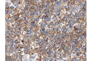 ABIN6266637 at 1/100 staining human lung carcinoma tissue sections by IHC-P. (CSTB antibody  (C-Term))