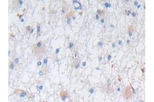 Detection of NES in Human Glioma Tissue using Polyclonal Antibody to Nestin (NES) (Nestin antibody  (AA 178-399))