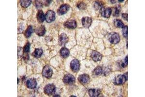 IHC analysis of FFPE human prostate carcinoma tissue stained with PDGFR alpha antibody (PDGFRA antibody  (AA 740-769))