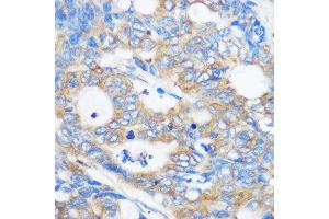 Immunohistochemistry of paraffin-embedded Human colon carcinoma using PEBP4 Rabbit pAb (ABIN7269280) at dilution of 1:100 (40x lens). (PEBP4 antibody)