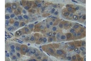 Detection of MMP7 in Human Liver cancer Tissue using Polyclonal Antibody to Matrix Metalloproteinase 7 (MMP7)