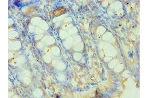 Immunohistochemistry of paraffin-embedded human colon tissue using ABIN7155524 at dilution of 1:100 (SMYD3 antibody  (AA 199-428))