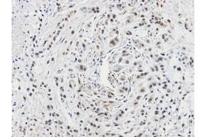 IHC-P Image Immunohistochemical analysis of paraffin-embedded A549 xenograft, using CacyBP, antibody at 1:100 dilution.