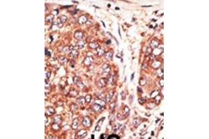 Formalin-fixed and paraffin-embedded human cancer tissue reacted with the primary antibody, which was peroxidase-conjugated to the secondary antibody, followed by AEC staining. (Septin 9 antibody  (C-Term))