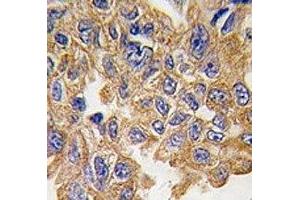IHC analysis of FFPE human lung carcinoma tissue stained with AKT2 antibody (AKT2 antibody  (AA 452-481))