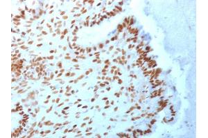 Formalin-fixed, paraffin-embedded human Endometrial Carcinoma stained with TLE1 Mouse Monoclonal Antibody (TLE1/2062).