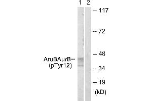 Immunohistochemistry analysis of paraffin-embedded human liver carcinoma tissue using AurB (Phospho-Tyr12) antibody. (Aurora Kinase B antibody  (pTyr12))