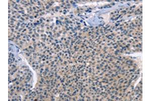 The image on the left is immunohistochemistry of paraffin-embedded Human liver cancer tissue using (LRRK2 Antibody) at dilution 1/30, on the right is treated with fusion protein.