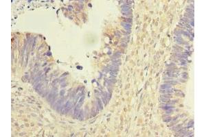 Immunohistochemistry of paraffin-embedded human ovarian cancer using ABIN7167439 at dilution of 1:100