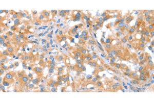 Immunohistochemistry of paraffin-embedded Human thyroid cancer tissue using ST14 Polyclonal Antibody at dilution 1:70 (ST14 antibody)