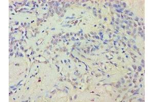 Immunohistochemistry of paraffin-embedded human breast cancer using ABIN7152359 at dilution of 1:100 (EYA2 antibody  (AA 1-514))