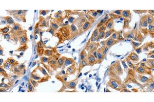 Immunohistochemistry of paraffin-embedded Human lung cancer using IGF2BP1 Polyclonal Antibody at dilution of 1:40 (IGF2BP1 antibody)