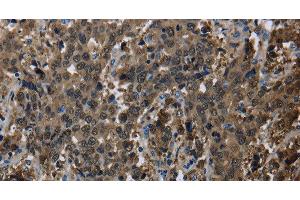 Immunohistochemistry of paraffin-embedded Human liver cancer using GSTA3 Polyclonal Antibody at dilution of 1:30 (GSTA3 antibody)