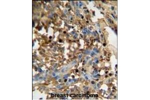 D antibody (C-term) (ABIN654936 and ABIN2844579) immunohistochemistry analysis in formalin fixed and paraffin embedded human breast carcinoma followed by peroxidase conjugation of the secondary antibody and DAB staining. (FAM20C antibody  (C-Term))