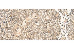 Immunohistochemistry of paraffin-embedded Human lung cancer tissue using NIP7 Polyclonal Antibody at dilution of 1:50(x200) (NIP7 antibody)