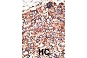 Formalin-fixed and paraffin-embedded human cancer tissue reacted with the primary antibody, which was peroxidase-conjugated to the secondary antibody, followed by DAB staining. (MMP17 antibody  (AA 391-420))