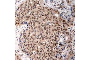Immunohistochemistry of paraffin-embedded human breast carcinoma using Phospho-MAPKAPK2-T334 antibody (ABIN2988148). (MAPKAP Kinase 2 antibody  (pThr334))