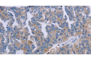 Immunohistochemistry of paraffin-embedded Human ovarian cancer tissue using P2RY2 Polyclonal Antibody at dilution of 1:40 (P2RY2 antibody)