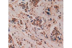 Used in DAB staining on fromalin fixed paraffin- embedded breast cancer tissue (ADAMTS5 antibody  (AA 485-622))