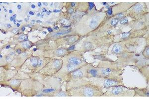 Immunohistochemistry of paraffin-embedded Human mammary cancer using CEACAM5 Monoclonal Antibody at dilution of 1:100 (40x lens). (CEACAM5 antibody)