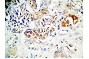 Human stomach cancer tissue was stained by rabbit anti-Spexin(H) Antiserum (Spexin antibody)