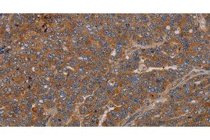 Immunohistochemistry of paraffin-embedded Human ovarian cancer using GDF2 Polyclonal Antibody at dilution of 1:40 (GDF2 antibody)
