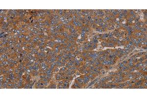 Immunohistochemistry of paraffin-embedded Human ovarian cancer using GDF2 Polyclonal Antibody at dilution of 1:40