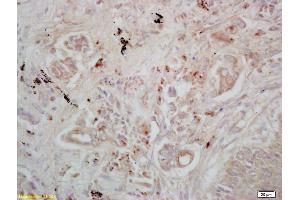 Formalin-fixed and paraffin embedded human lung carcinoma labeled with Rabbit Anti DAB2 Polyclonal Antibody, Unconjugated (ABIN760961) at 1:200 followed by conjugation to the secondary antibody and DAB staining (DAB2 antibody  (AA 31-130))