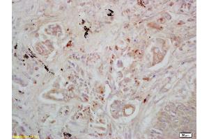 Formalin-fixed and paraffin embedded human lung carcinoma labeled with Rabbit Anti DAB2 Polyclonal Antibody, Unconjugated (ABIN760961) at 1:200 followed by conjugation to the secondary antibody and DAB staining
