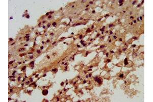 IHC image of ABIN7170595 diluted at 1:300 and staining in paraffin-embedded human melanoma performed on a Leica BondTM system. (SKA3 antibody  (AA 101-195))