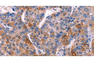 Immunohistochemistry of paraffin-embedded Human liver cancer tissue using DUSP13 Polyclonal Antibody at dilution 1:60 (DUSP13 antibody)
