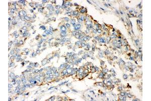 Anti- WNT2B Picoband antibody, IHC(P) IHC(P): Human Lung Cancer Tissue (WNT2B antibody  (N-Term))