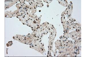 Immunohistochemical staining of paraffin-embedded Adenocarcinoma of breast tissue using anti-BUB1B mouse monoclonal antibody. (BUB1B antibody)
