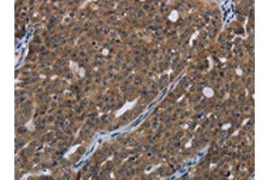 The image on the left is immunohistochemistry of paraffin-embedded Human ovarian cancer tissue using ABIN7190993(HOXC8 Antibody) at dilution 1/20, on the right is treated with synthetic peptide. (HOXC8 antibody)