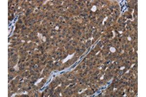 The image on the left is immunohistochemistry of paraffin-embedded Human ovarian cancer tissue using ABIN7190993(HOXC8 Antibody) at dilution 1/20, on the right is treated with synthetic peptide.