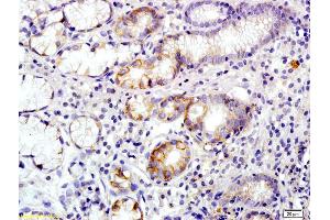 Formalin-fixed and paraffin embedded human colon carcinoma labeled with Rabbit Anti Annexin A13 Polyclonal Antibody, Unconjugated (ABIN1714416) at 1:200 followed by conjugation to the secondary antibody and DAB staining (Annexin A13 antibody  (AA 241-316))