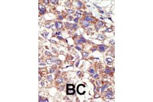 Formalin-fixed and paraffin-embedded human cancer tissue reacted with the DNMT3B polyclonal antibody  , which was peroxidase-conjugated to the secondary antibody, followed by AEC staining. (DNMT3B antibody  (Internal Region))