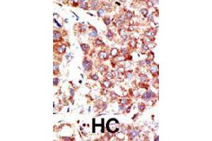 Formalin-fixed and paraffin-embedded human hepatocellular carcinoma tissue reacted with NEDD8 polyclonal antibody  , which was peroxidase-conjugated to the secondary antibody, followed by DAB staining. (NEDD8 antibody  (N-Term))